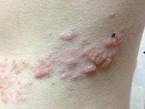 疱疹可以吃蒲瓜